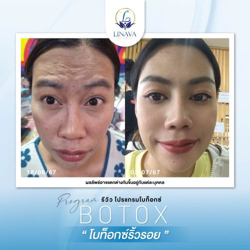 Review Botox-02